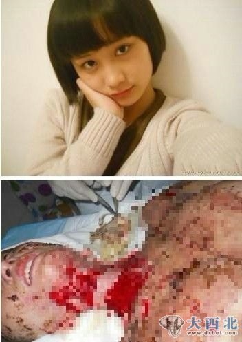 周岩被烧伤前后对比(图片来自家属微博)。 周岩被烧伤前后对比(图片来自家属微博)。